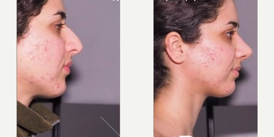 Rhinoplasty before and after photo