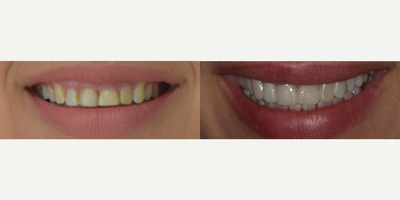 Smile Makeover before and after photo