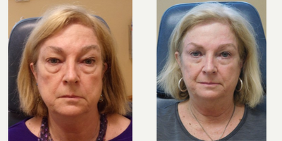 Eyelid Surgery before and after photo