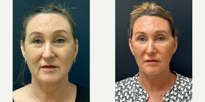 Facelift before and after photo