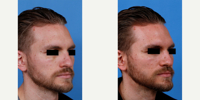 Facial Reconstructive Surgery before and after photo