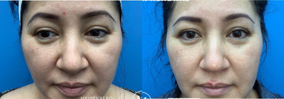 Laser Resurfacing before and after photo