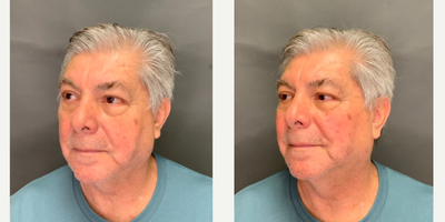 Radiesse before and after photo