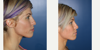Rhinoplasty before and after photo