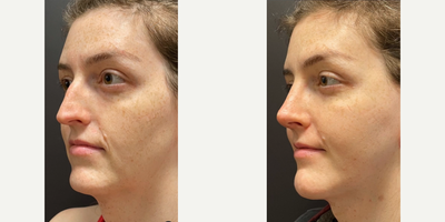 Rhinoplasty before and after photo