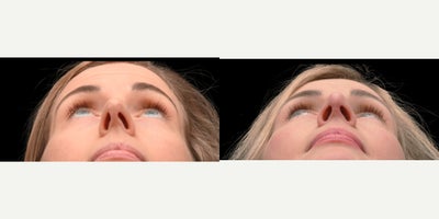 Rhinoplasty before and after photo