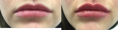 Dermal Fillers before and after photo