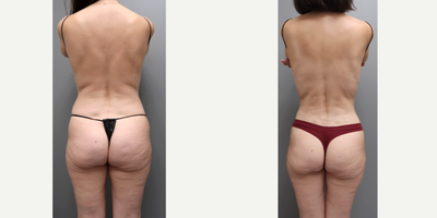 Tummy Tuck before and after photo