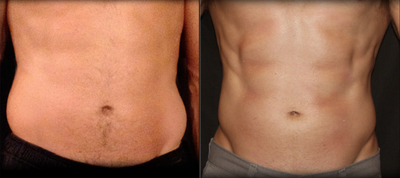 CoolSculpting before and after photo