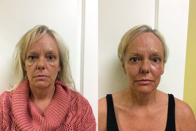 Dermal Fillers before and after photo
