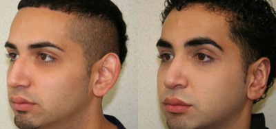 Ear Surgery before and after photo