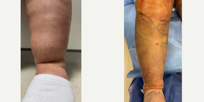 Vaser Liposuction before and after photo