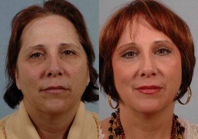 Brow Lift before and after photo