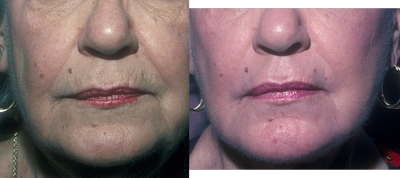 Chemical Peel before and after photo