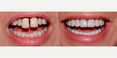 Dental Crown before and after photo