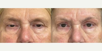 Eyelid Surgery before and after photo