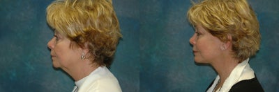 Facelift before and after photo
