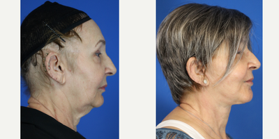 Facelift before and after photo