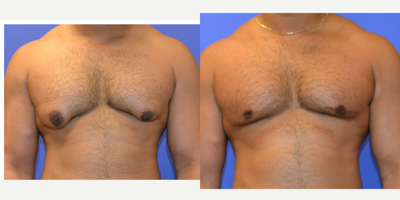 Gynecomastia Surgery before and after photo