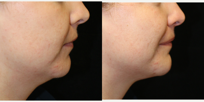 Juvederm before and after photo