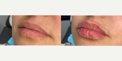 Lip Fillers before and after photo