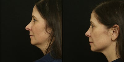 Revision Rhinoplasty before and after photo