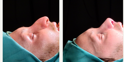 Rhinoplasty before and after photo