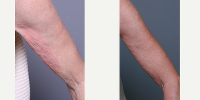 Thermage before and after photo