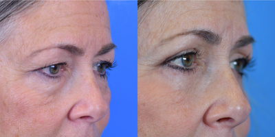 Eyelid Surgery before and after photo
