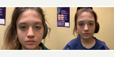 Ptosis Surgery before and after photo