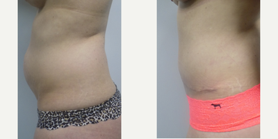 Tummy Tuck before and after photo