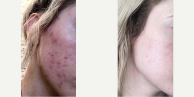 Chemical Peel before and after photo