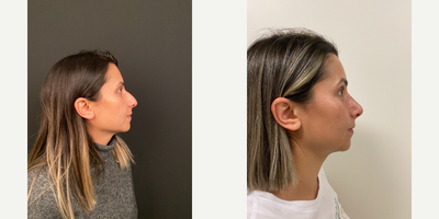 Juvederm before and after photo