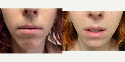 Lip Surgery before and after photo