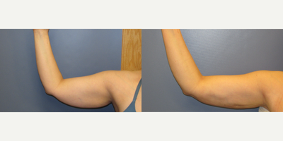 Liposuction before and after photo