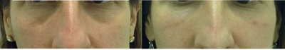 PRP Injections before and after photo