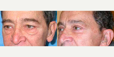 Brow Lift before and after photo