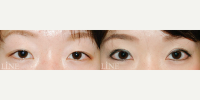 Double Eyelid Surgery before and after photo