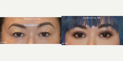 Double Eyelid Surgery before and after photo
