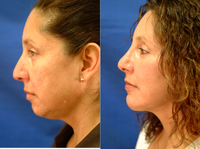 Facelift before and after photo