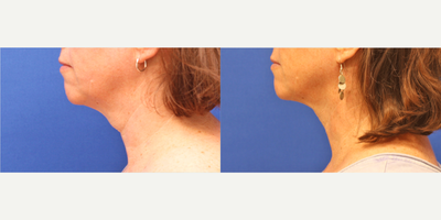 PrecisionTx before and after photo