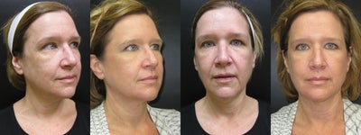 Ultherapy before and after photo
