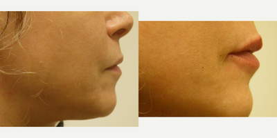 Lip Fillers before and after photo