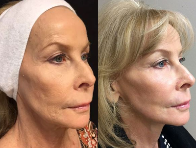 before and after image