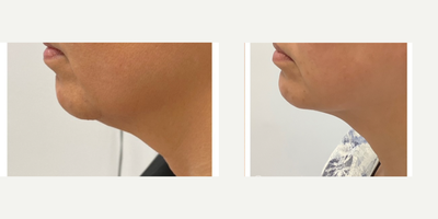 Kybella before and after photo