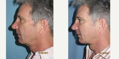 Neck Lift before and after photo