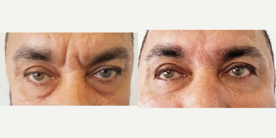 Dermal Fillers before and after photo