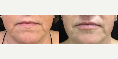Dermal Fillers before and after photo