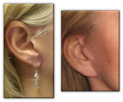 Earlobe Repair before and after photo