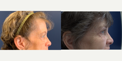 Eyelid Surgery before and after photo